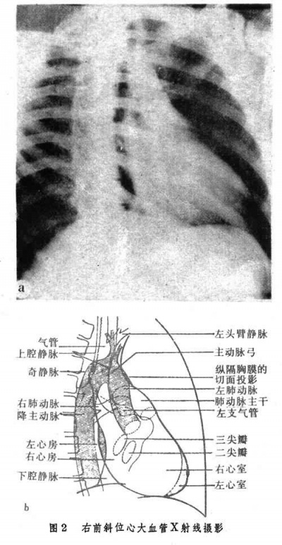 右前斜位心大血管X射线.jpg